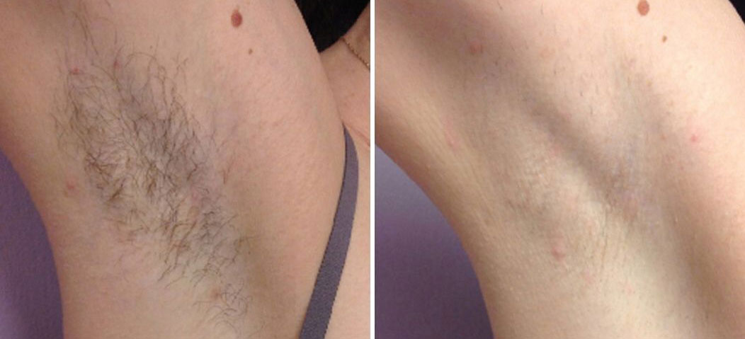 Laser Hair Removal