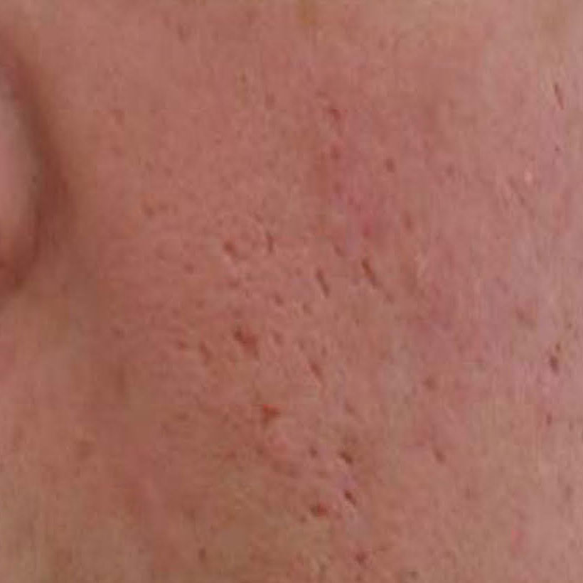 Ablative Laser Skin Resurfacing