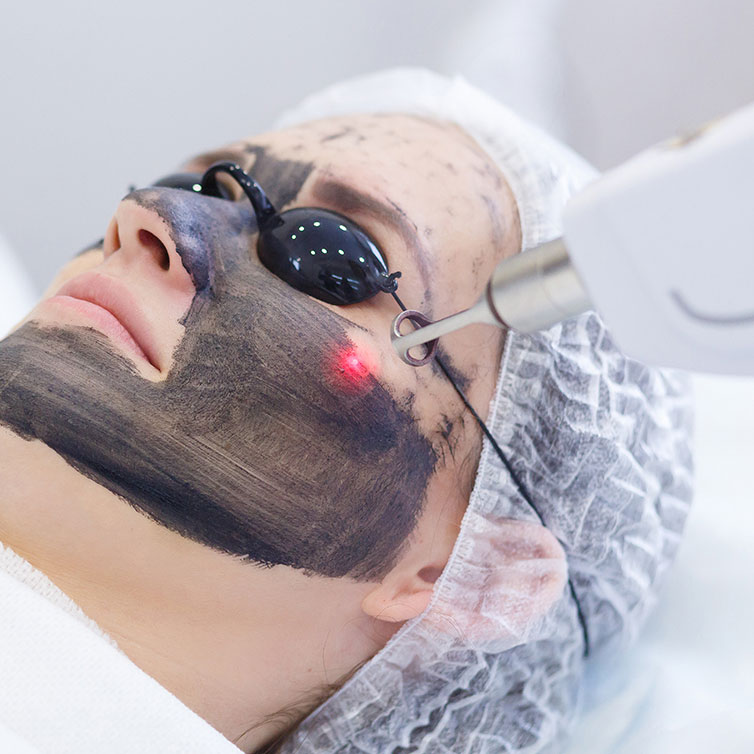 Carbon Laser Treatment