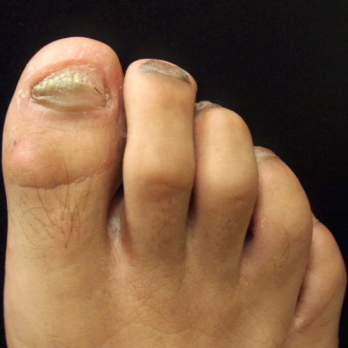 Fungal Nail Treatment